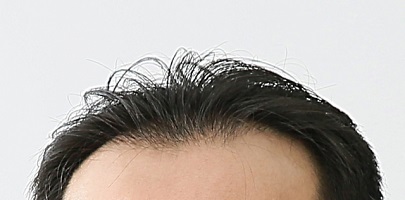 新増毛法クイックポンとは？円形脱毛症に最適なその特徴や評価、口コミを紹介します。
