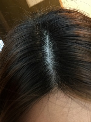 女性用育毛剤「MIYABIKA」（ミヤビカ）の発毛効果と副作用について