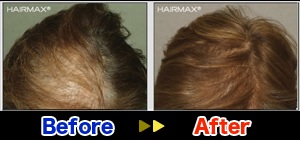 hairmax6