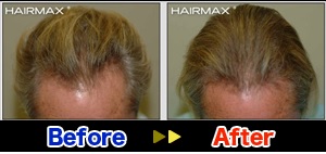 [画像]ヘアマックスの効果を写真で比較！発毛本数の臨床データの内容は？