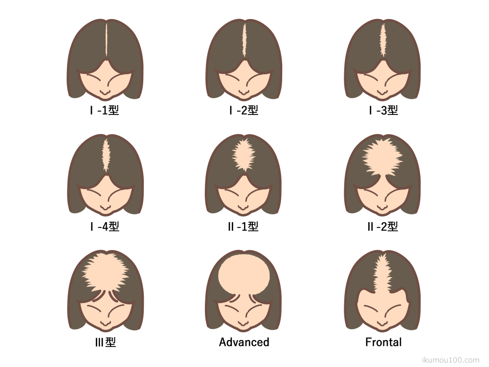[画像]女性の薄毛進行度を知るためのルードヴィヒ分類と進行に合わせた薄毛対策