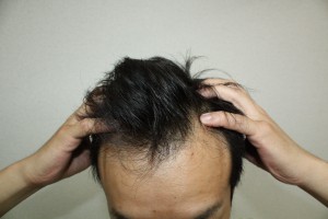 育毛・薄毛と頭皮の色の関係。健康的な頭皮は何色なのだろうか？