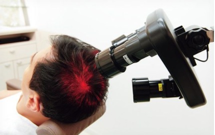 赤色LEDの発毛効果で、頭皮のコラーゲンが増える！低出力レーザーが育毛に効く理由。